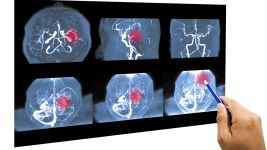 Ishemija mozga: Uzroci, simptomi i tretmani