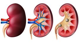 Kalkuloza bubrega: Uzroci, simptomi i terapija