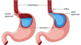 Divertikulum jednjaka: Uzroci i opcije lečenja