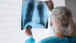 Uzroci i simptomi infarkta pluća