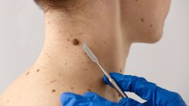 Tumori kože: Rani znaci i kada potražiti lekarsku pomoć