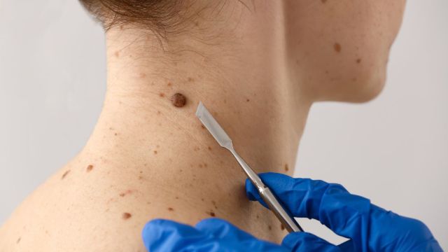 Tumori kože: Rani znaci i kada potražiti lekarsku pomoć Tumori kože: Rani znaci i kada potražiti lekarsku pomoć
